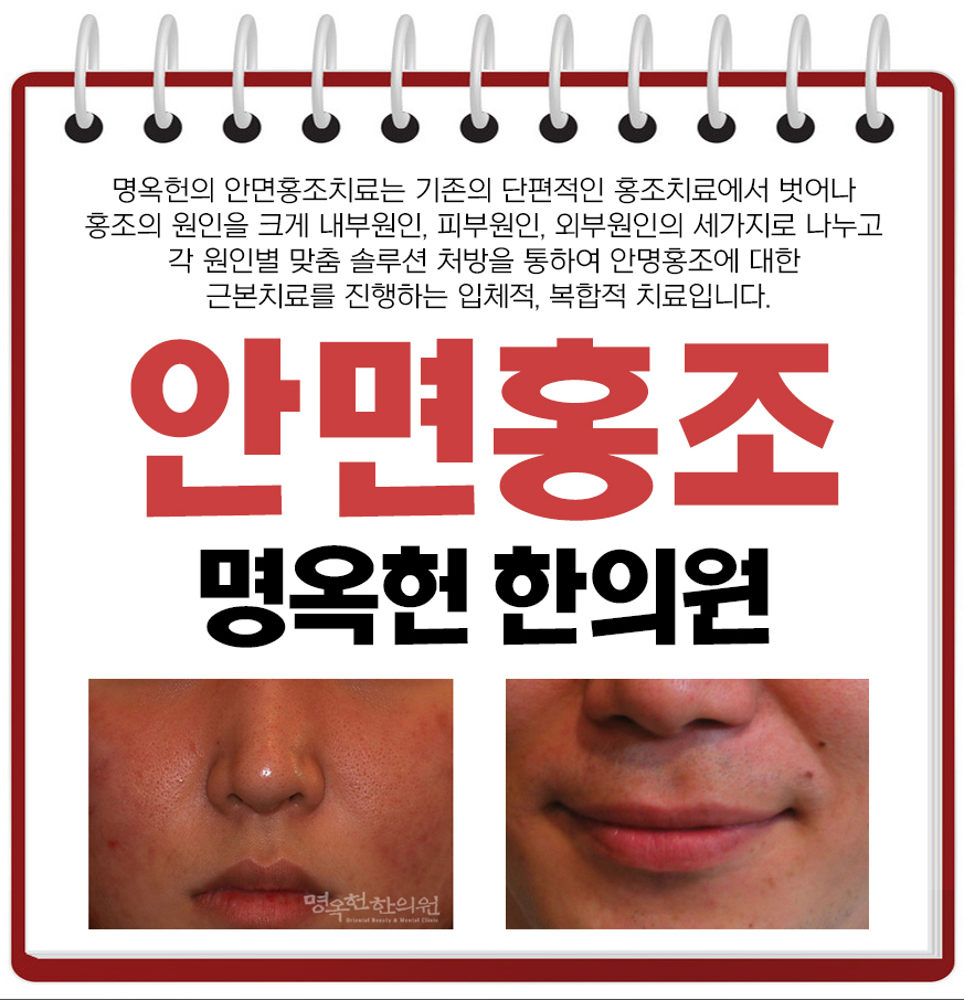 %EC%95%88%EB%A9%B4%ED%99%8D%EC%A1%B0_w966