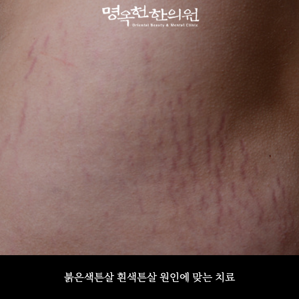 %ED%8A%BC%ED%8A%BC%EC%8D%B8_w966